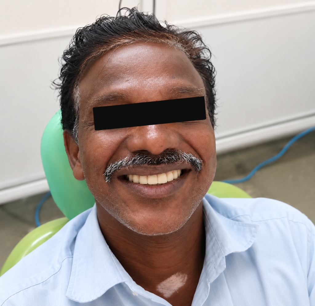 Ramaraj - Removable Partial Denture After