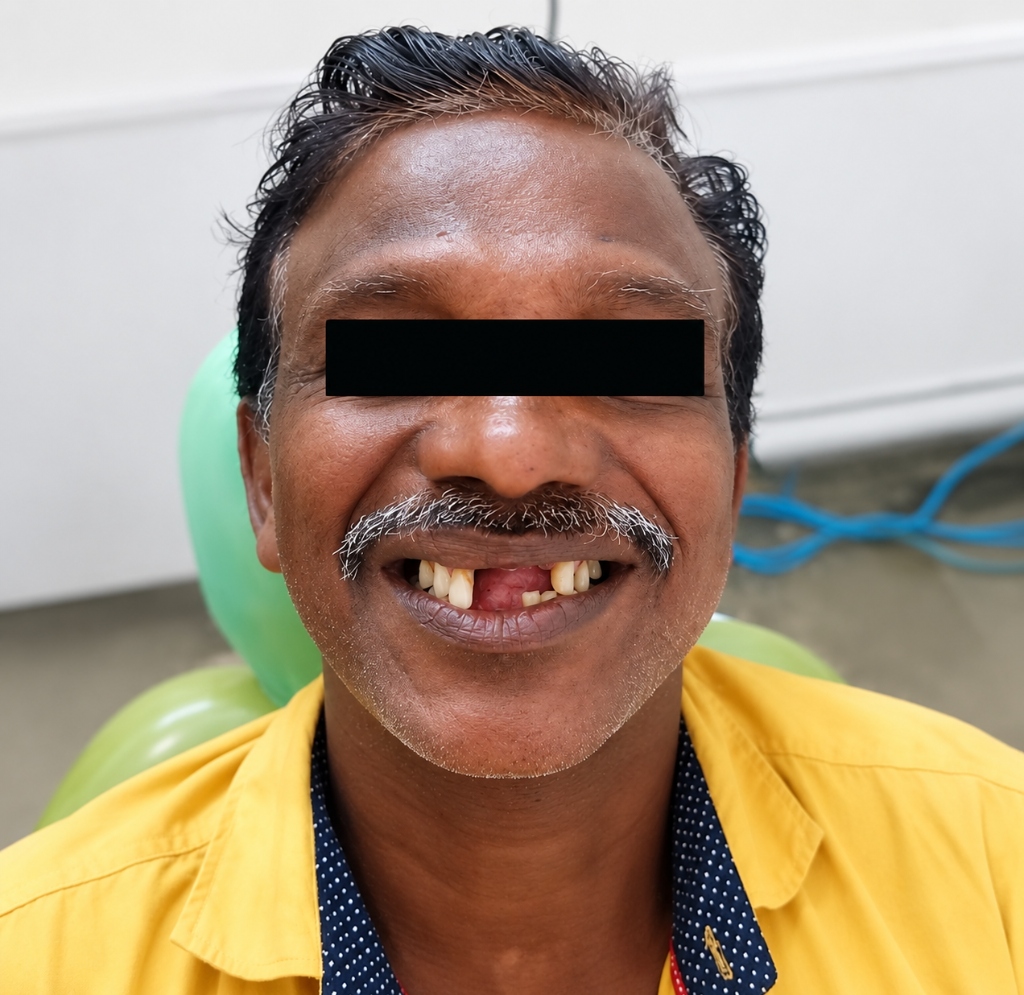 Ramaraj - Removable Partial Denture Before