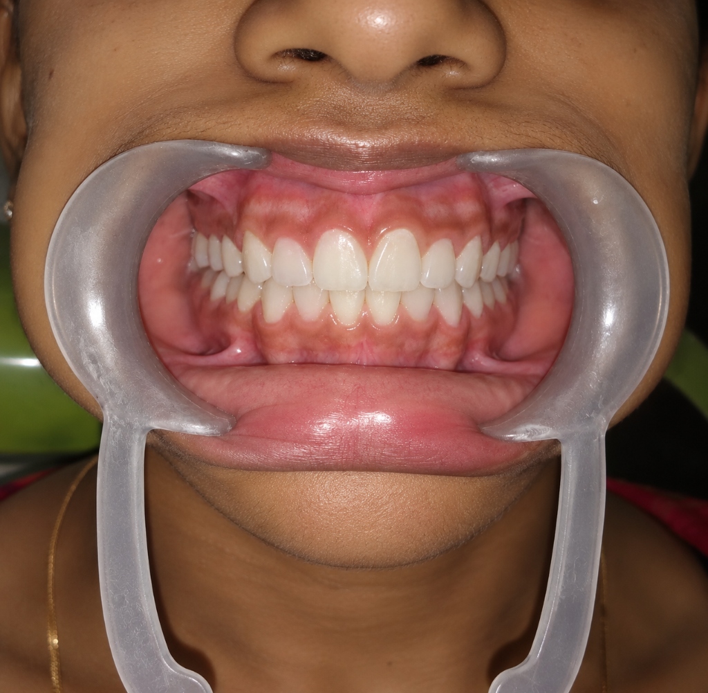 Diviya - Cast Post & Zirconia Crown